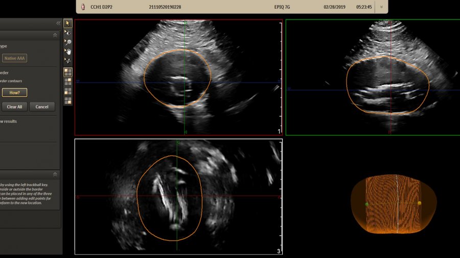 aneurisma-aorta-abdominal-philips