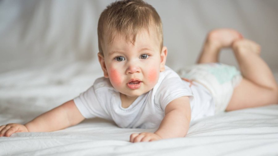 Bebé con dermatitis atópica.