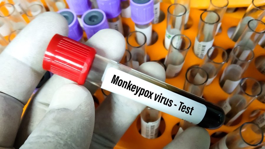 Viruela del mono, símica o monkeypox