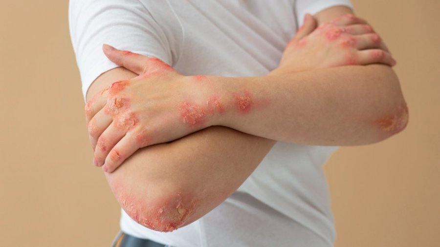 Sotyktu (deucravacitinib) para pacientes con psoriasis en placas 