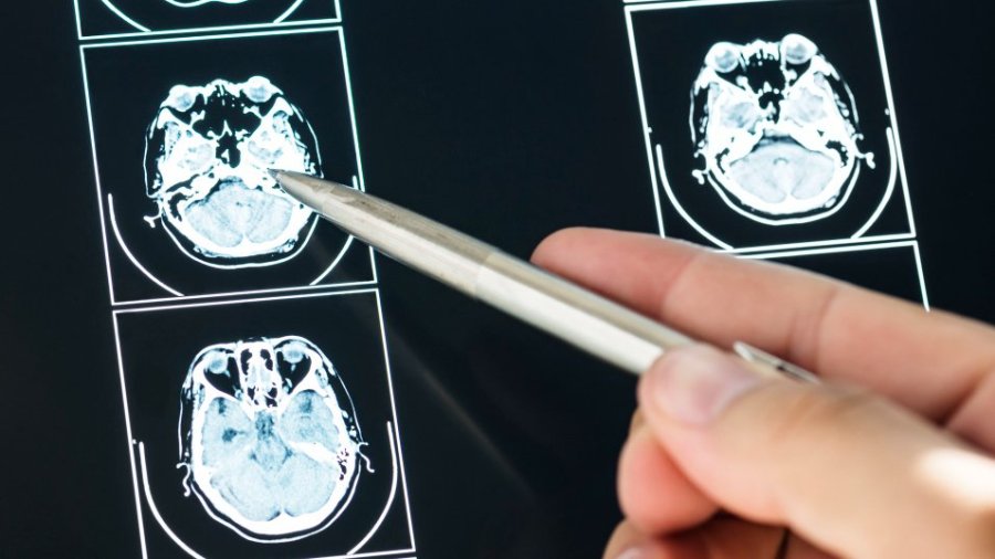 Investigación contra el glioma pontino intrínseco difuso