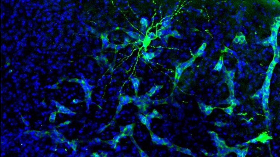  tumores cerebrales ‘hackean’ la comunicación entre las neuronas