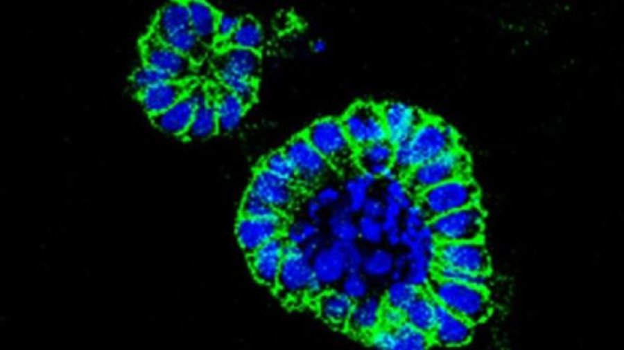 Organoide de cáncer de colon.