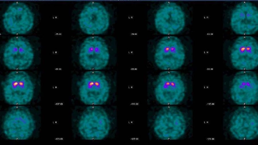 Imagen de SPECT con ioflupano (Datos de archivo, GE HealthCare)